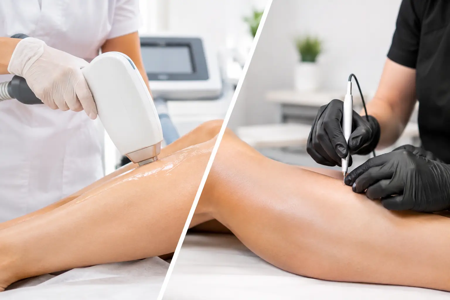 Laser Hair Removal Versus Electrolysis: Which Is Right for You?